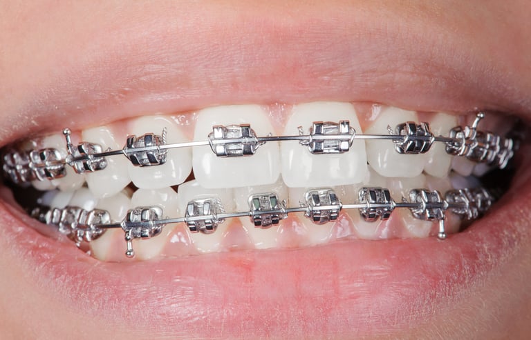 Sorriso senza limiti di età La guida completa agli apparecchi ortodontici per adulti e bambini