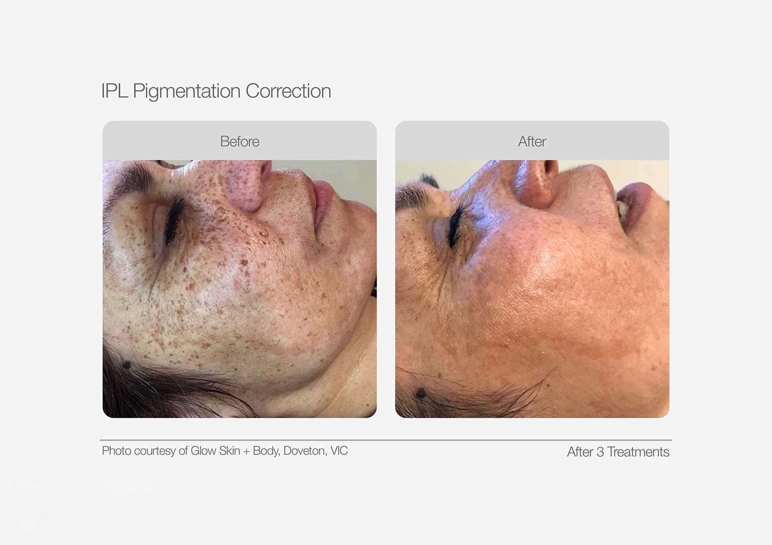 IPL Pigmentation Correction Before & After 07