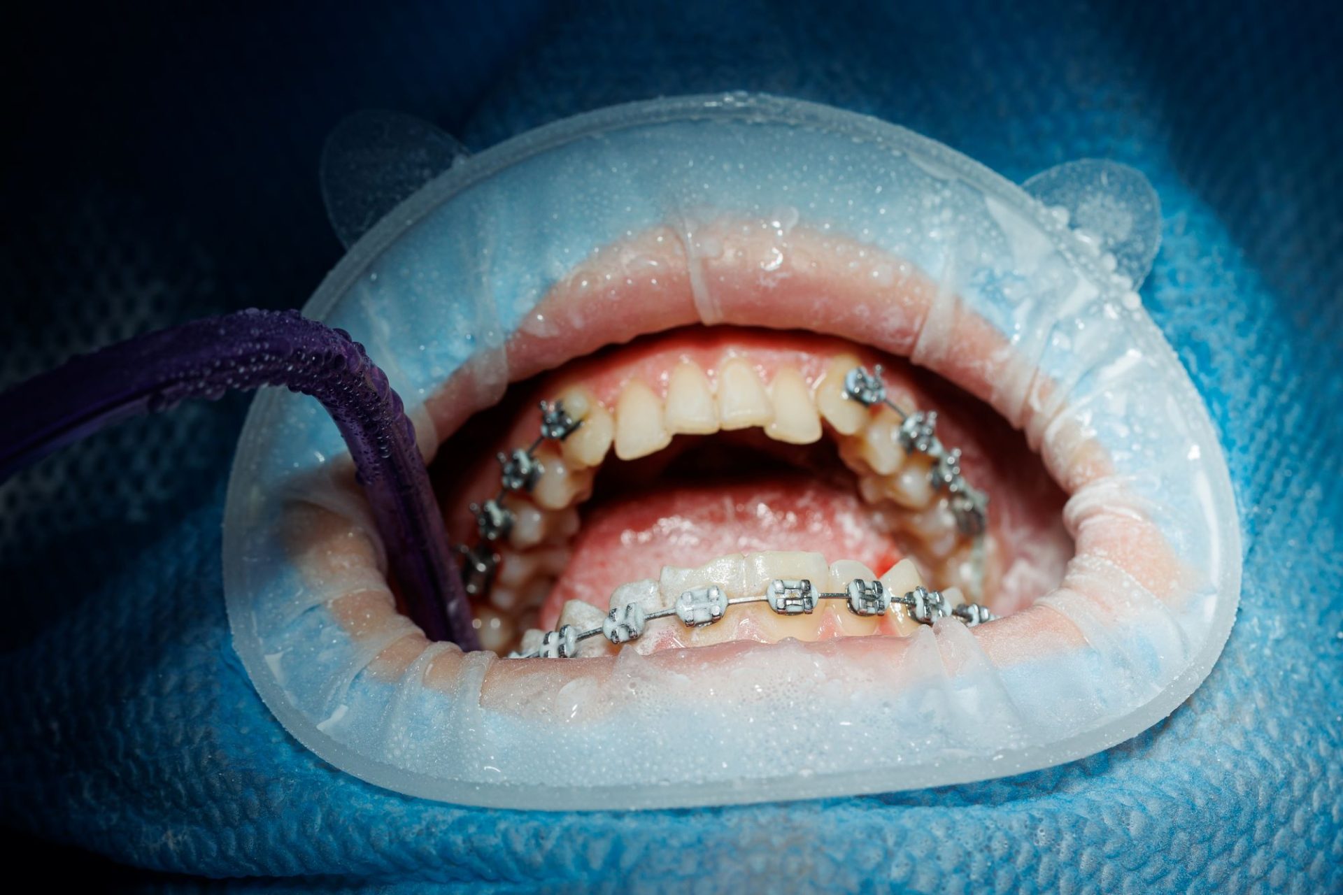 Common Mistakes People Make When Getting Clear Aligners