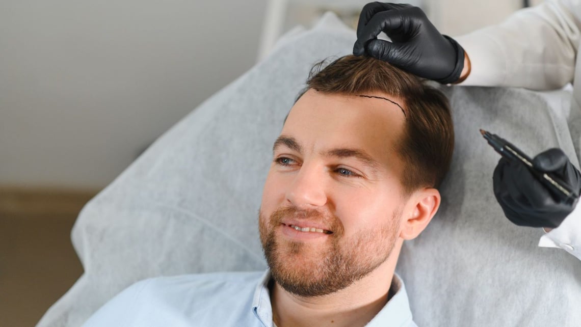 The Art of Precision Hair Transplants: Where Beauty Meets Individual Style