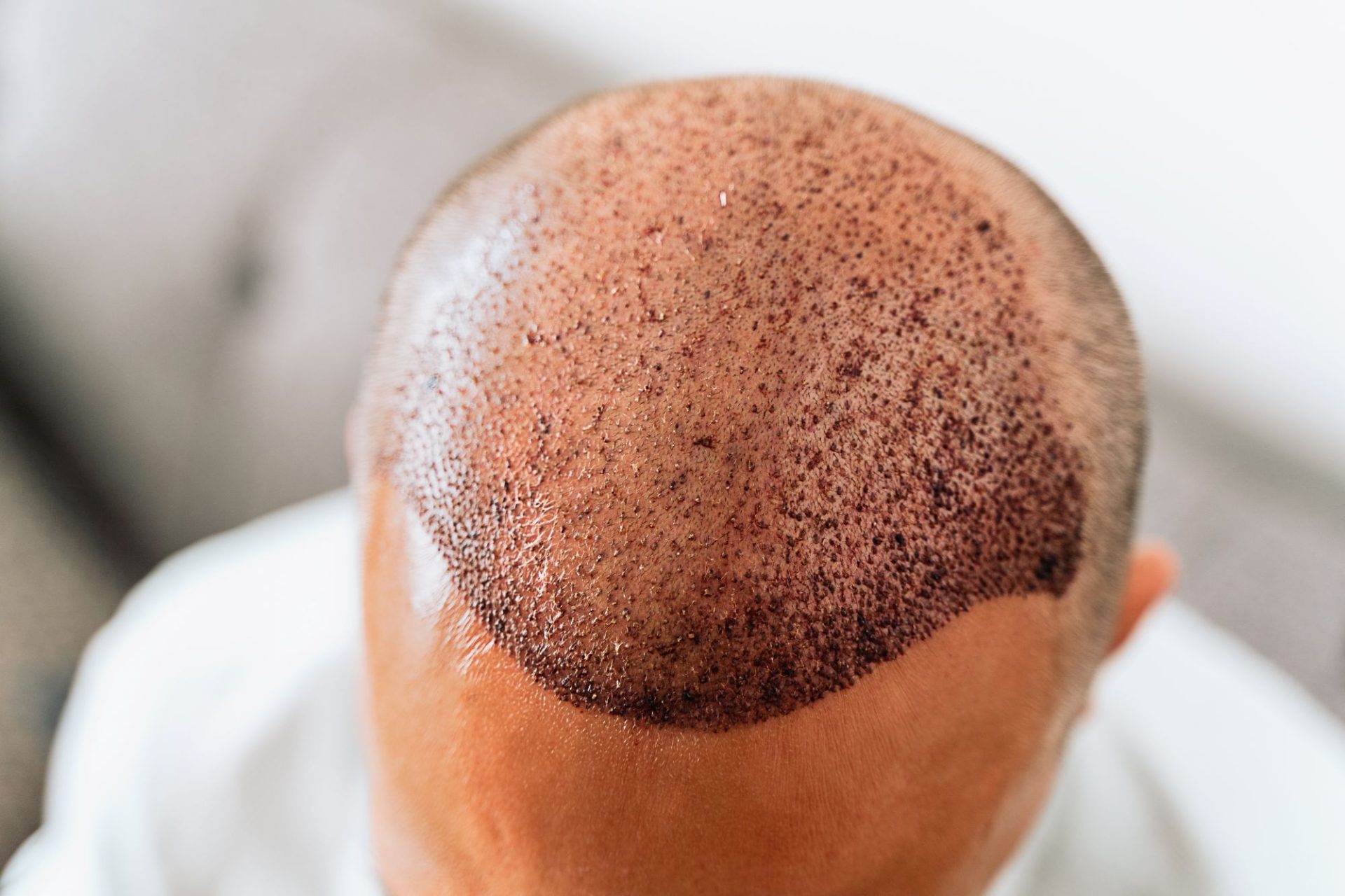 The Art of Precision Hair Transplants Where Beauty Meets Individual Style